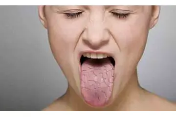 Boğaz Kuruluğu Yutkunma Zorluğu Nasıl Geçer?